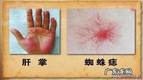 颈椎病为什么很多老中医都说不好zhi？