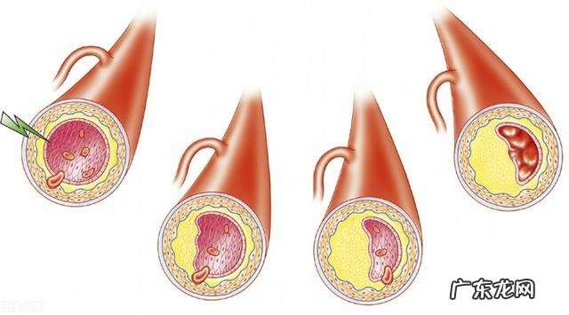 血脂高有什么症状表现？怎样降血脂？