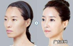 瘦脸针美白针图片 美白针和瘦脸针可以维持多久