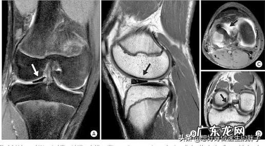 膝盖痛,是做厨房的代价吗