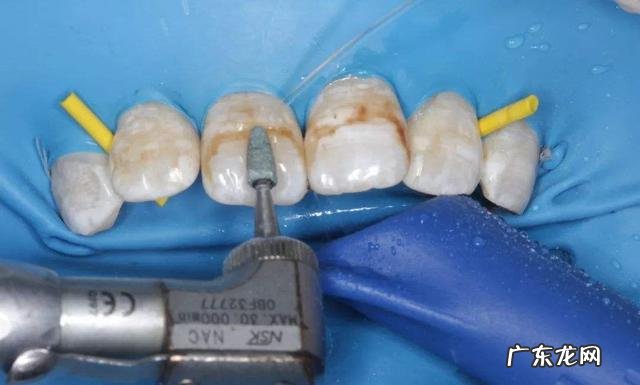 用什么美白牙齿最快 牙齿美白在家最快最有效