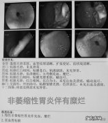 糜烂性胃炎吃肉和醋有影响吗？