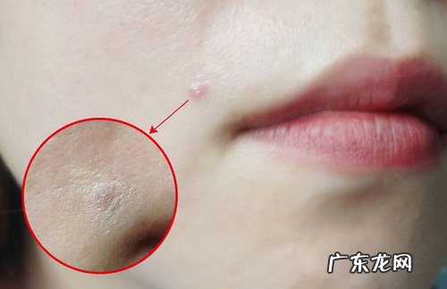 收集盛行语的祛痘的要领牢靠吗?