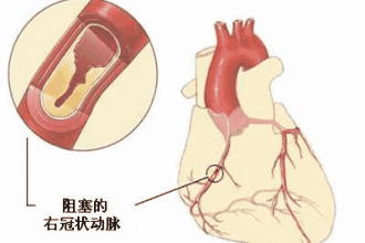 人到多大年龄,动脉会开始长斑块并出现硬化的现象