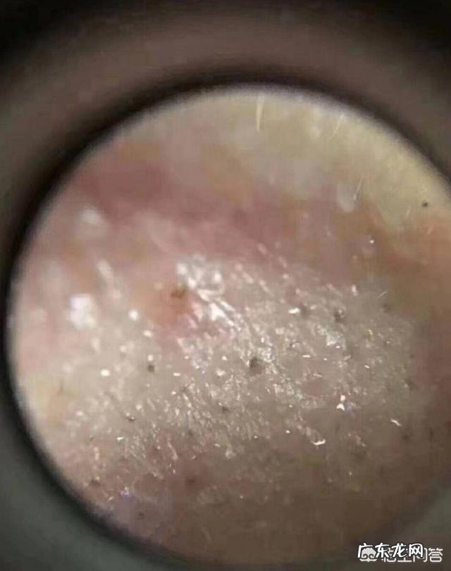 脸上2种异常，已经是肝病晚期，是哪2种