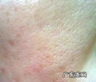 脸上2种异常，已经是肝病晚期，是哪2种