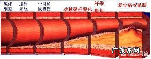 动脉粥样硬化能够被逆转,是真的吗?