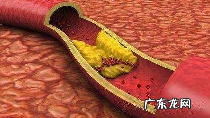 动脉粥样硬化能够被逆转,是真的吗?