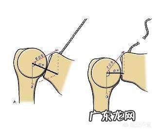 斜方肌大,溜肩怎么改善?