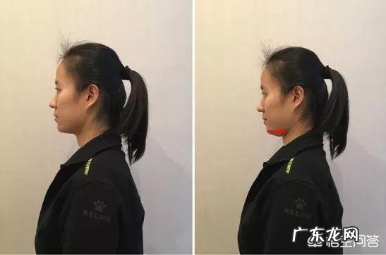 斜方肌大,溜肩怎么改善?