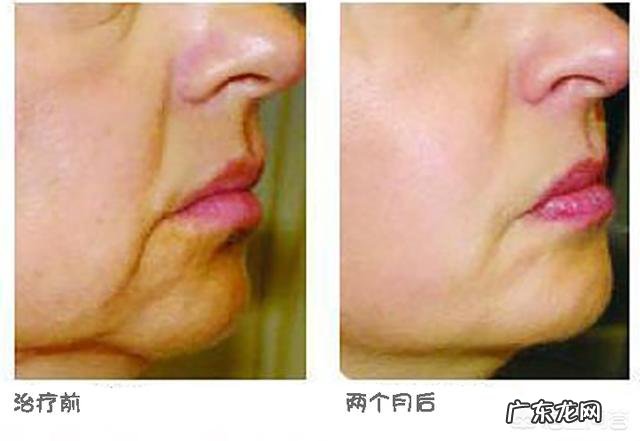 要怎么样才能去除法令纹和木偶纹呢,有没有什么好方法?