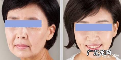 要怎么样才能去除法令纹和木偶纹呢,有没有什么好方法?