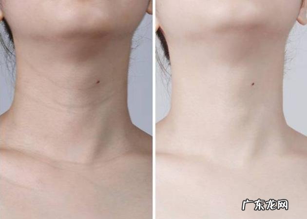 女人法令纹不花钱怎样祛除?