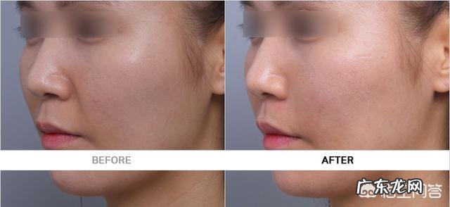 女人法令纹不花钱怎样祛除?