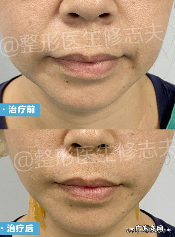 女人法令纹不花钱怎样祛除?