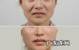 女人法令纹不花钱怎样祛除?