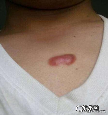 瘢痕体质的人有什么特别的体验