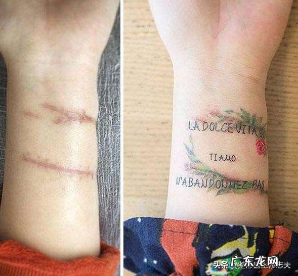 瘢痕体质的人有什么特别的体验