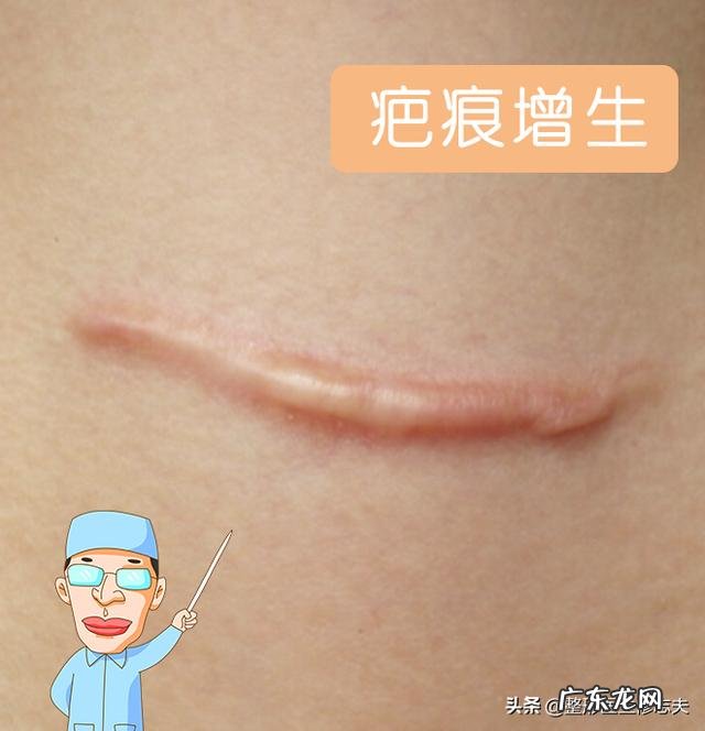 瘢痕体质的人有什么特别的体验