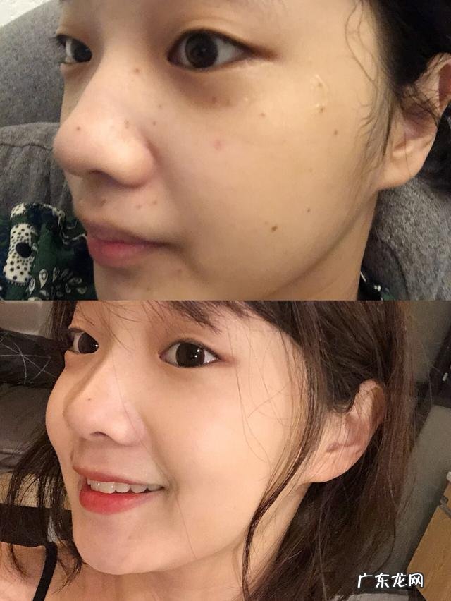 请问激光祛斑后可以用哪些的水乳呢?