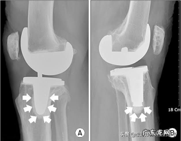 老年人如何才能避免肌肉过快流失?如何才能健康的老去呢?