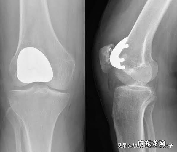 老年人如何才能避免肌肉过快流失?如何才能健康的老去呢?