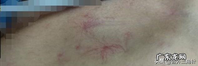 脸上出现哪些迹象说明肝已病变