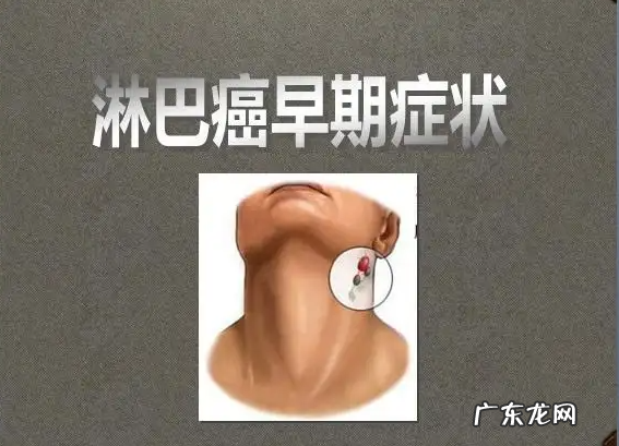 脖子淋巴癌早期症状图片-颈部淋巴癌的早期表现
