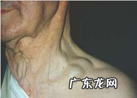 脖子淋巴癌早期症状图片-颈部淋巴癌的早期表现
