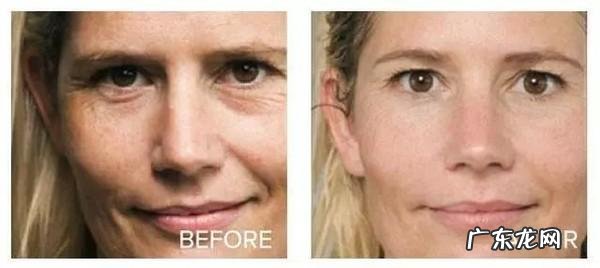 全身美白项目 美白针项目名称