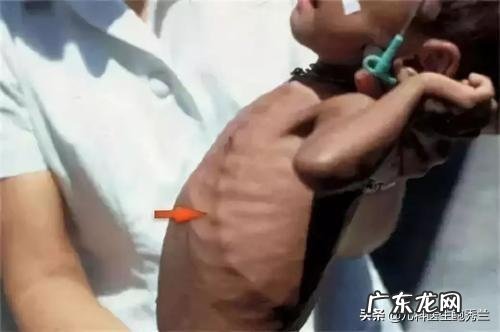 六个月婴儿肋骨一块特别突出是怎么回事？