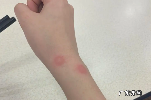 被跳蚤咬的症状是什么样的-被跳蚤咬的症状图片