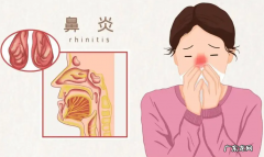 过敏性鼻炎患者可以喝茶吗