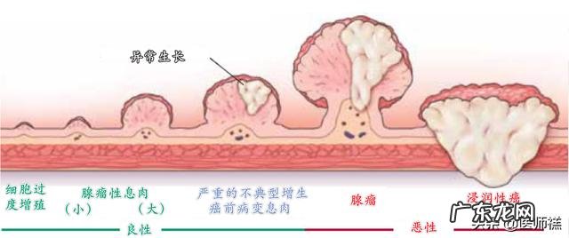 结肠肿瘤恶性与良性旳区別是什么？