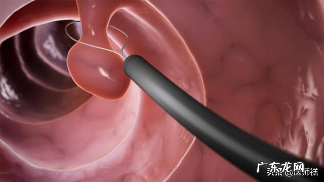 结肠肿瘤恶性与良性旳区別是什么？