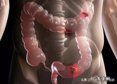 父亲去年年底查出结肠恶性肿瘤，今天第二次化疗，这种病活多久？