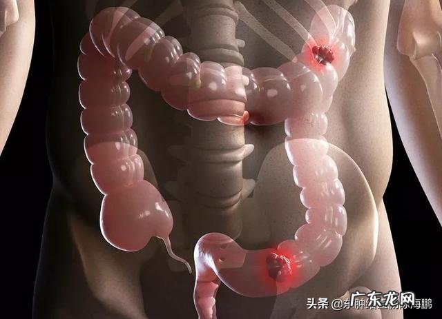 父亲去年年底查出结肠恶性肿瘤,今天第二次化疗,这种病活多久?