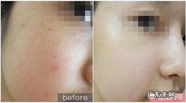 为了保持效果，水光针需要多久打一次？