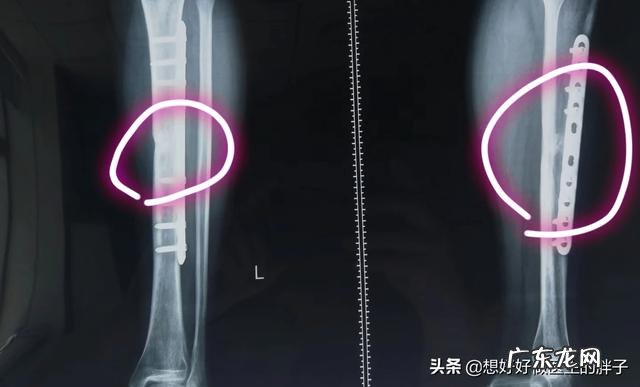 神奇的体外冲击波疗法,是怎样的操作