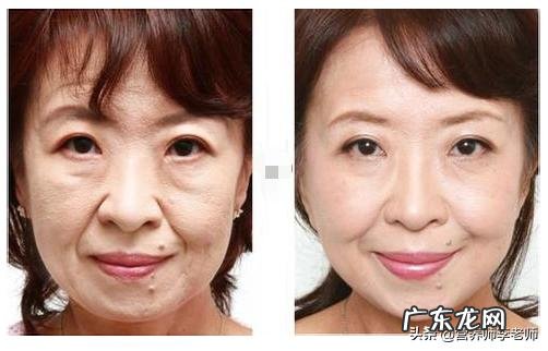 减重成功后,脸部皮肤松弛,眼窝凹陷怎么办?