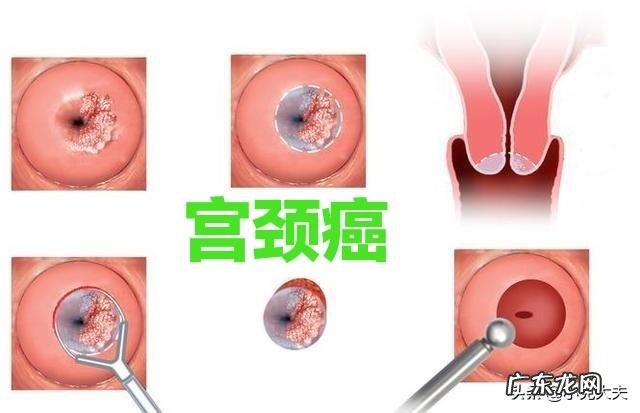 怎样才能有效预防子宫颈癌HPV? 怎样预防宫颈癌和hpv