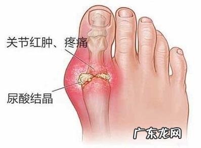 如何预防高尿酸血症的发生