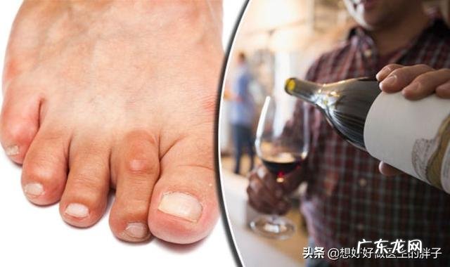 为何“痛风”越来越多?哪些饮食习惯不改,尿酸易“超标”?