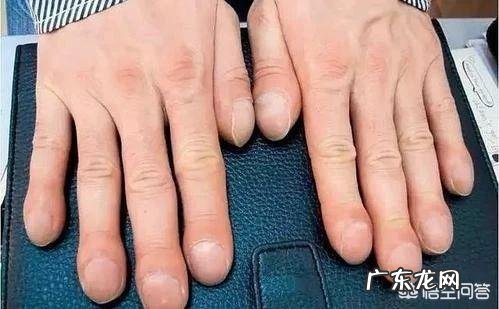 对比新冠肺炎和癌症、重症,大家怎么看? 怎么分辨新冠肺炎重症