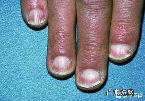 对比新冠肺炎和癌症、重症,大家怎么看? 怎么分辨新冠肺炎重症