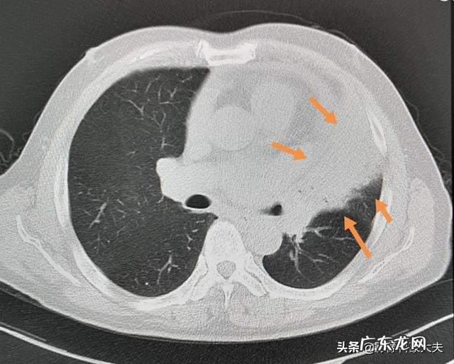 肺不张没有住院,现在没有什么症状靠锻炼能好吗?