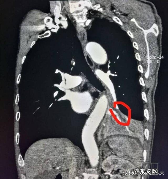 肺不张没有住院,现在没有什么症状靠锻炼能好吗?