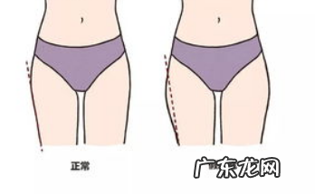 我只想抽大腿 抽脂真的能减肥吗?有没有什么风险和后遗症?