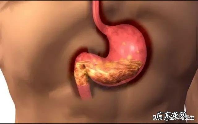 胃不好,经常打嗝、反酸、胃胀,是小毛病吗,该注意什么?