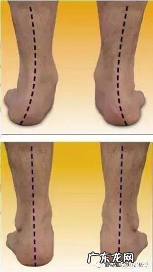 跑步后小腿变粗怎么恢复?